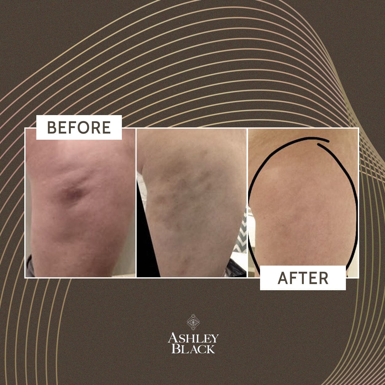 FasciaBlaster® Nugget Color Black 5