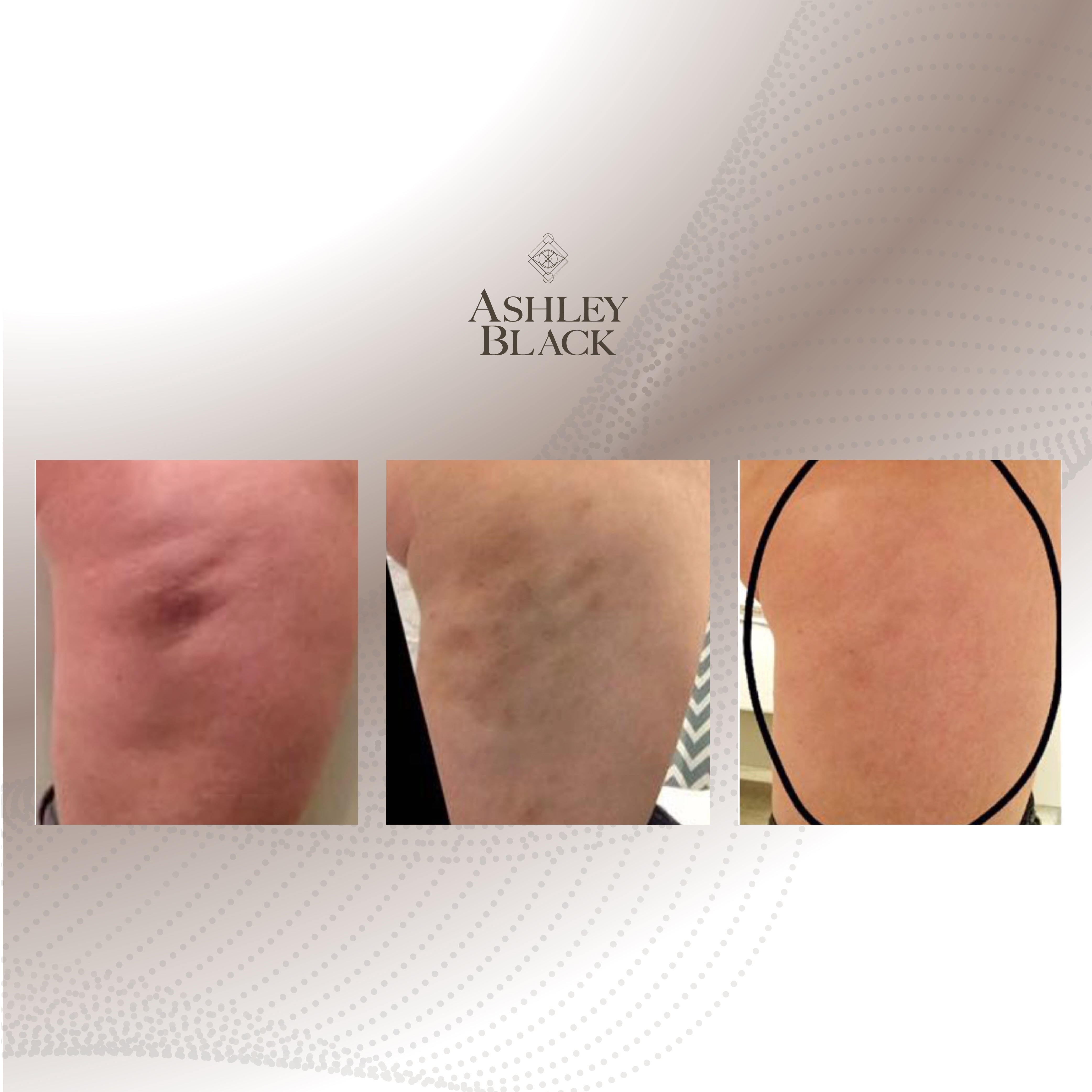 FasciaBlaster® Nugget Color White 5