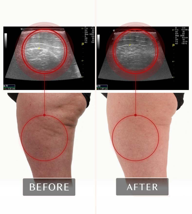 Before and after images of legs and ultrasounds from a FasciaBlaster study, showing significantly improved tissue health and fascia regeneration.