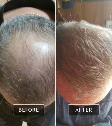 Dramatic before and after images showing a man’s hair regrowth, illustrating potential scalp health benefits from FasciaBlaster use.