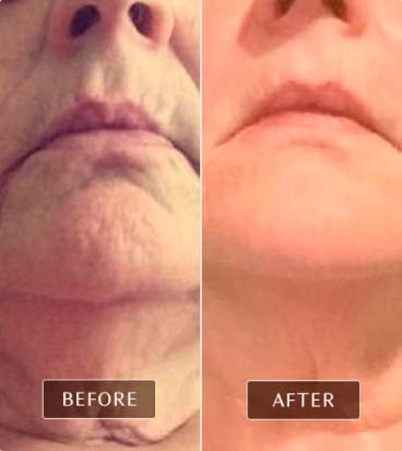 Before and after images showing a sculpted neck and chin, with reduced sagging after FasciaBlaster treatment.