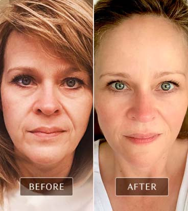 Dramatic before and after images of a real user illustrating facial rejuvenation and improved skin tone after using FasciaBlaster face tools.