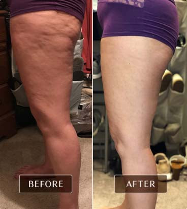 Before and after images of real user revealing reduced cellulite on the legs after consistent use of FasciaBlaster tools for fascia treatment.