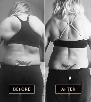 Dramatic before and after images of real user showcasing improved posture and alignment after FasciaBlaster treatment for scoliosis.