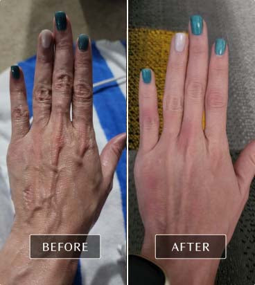 Before and after images of real user showing significant fascia improvement and rejuvenation of the hands through FasciaBlaster treatment.